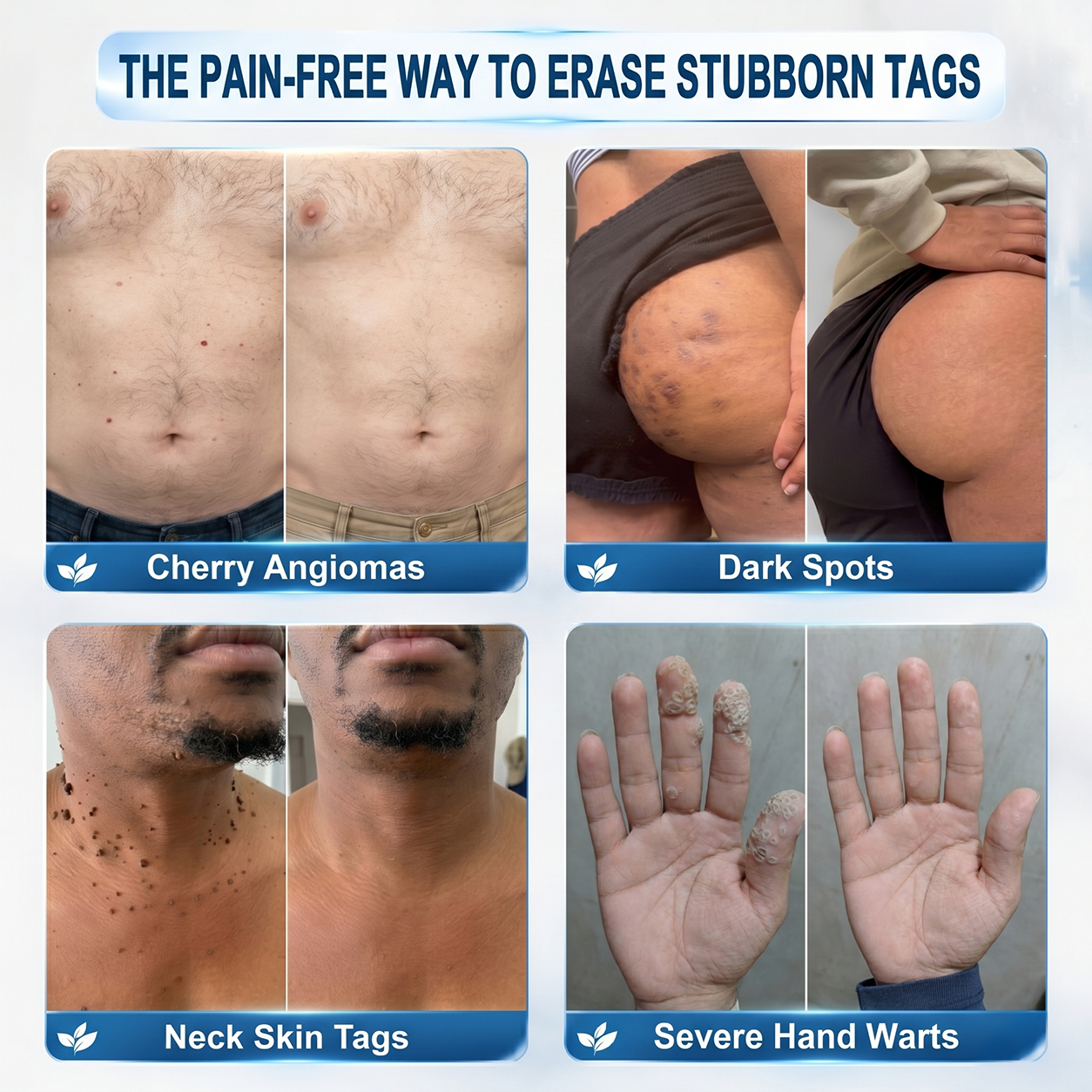 Official Store | 🎁 🎁𝐏i𝐜𝐝o® 7-Day Skin Tag & Spot Remover Serum