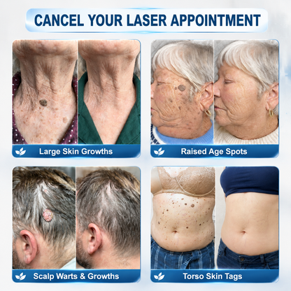 Official Store | 🎁 🎁𝐏i𝐜𝐝o® 7-Day Skin Tag & Spot Remover Serum