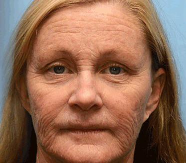 ✅Regain youthful skin nown 👩‍⚕️🎁 STDEI® BOTOX & VITA A RETINOL SHOT Wrinkle Lift Tightening Cream