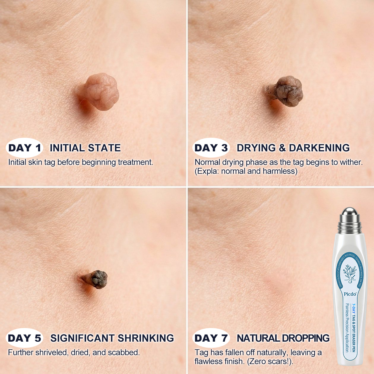 Official Store | 🎁 🎁𝐏i𝐜𝐝o® 7-Day Skin Tag & Spot Remover Serum