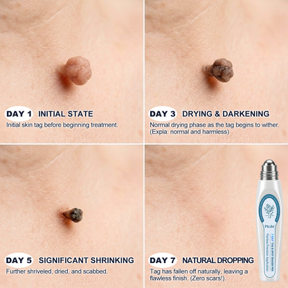 Official Store | 🎁 🎁𝐏i𝐜𝐝o® 7-Day Skin Tag & Spot Remover Serum